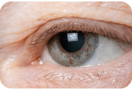 goz-kapagi-ameliyati-1