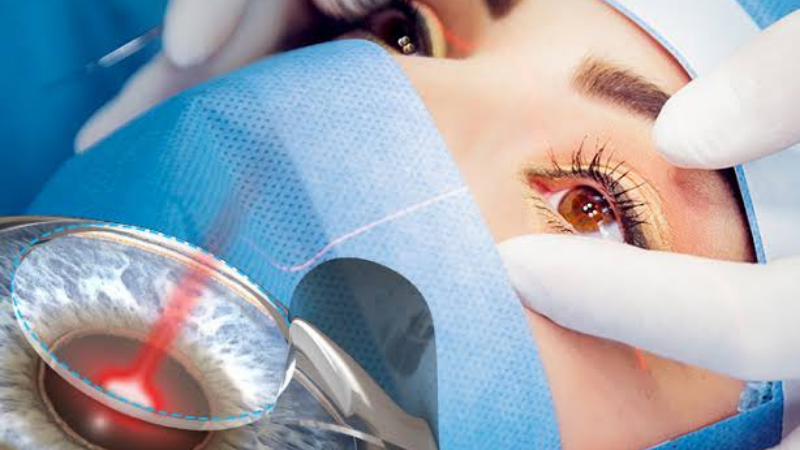 iLasik (Femto Lazer)